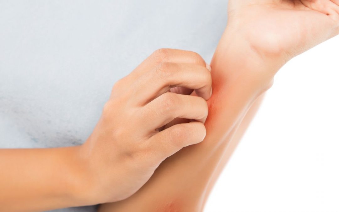 Natural Treatments for Eczema