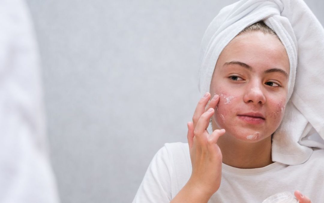 Tackling Acne by Balancing Blood Sugar and Hormones