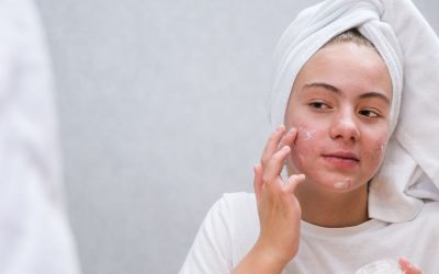 Tackling Acne by Balancing Blood Sugar and Hormones
